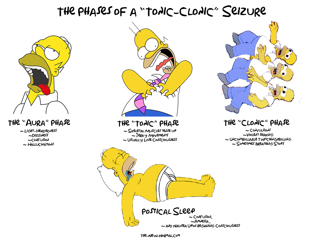 What is a tonic-clonic seizure?